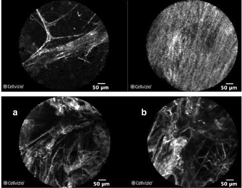 CONFOCAL LASER ENDOMiKROSKOPİ Prob ve lazer kullanarak, bronkoskopi sırasında in vivo mikroskobik