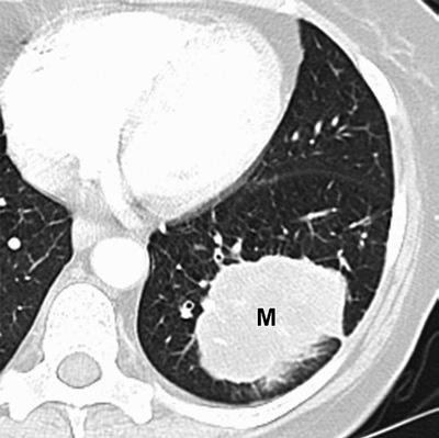 T3 Tümör T3: 5-7 cm Parietal plevra invazyonu (PL3) Göğüs duvarı invazyonu