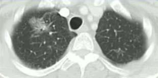 Multifokal buzlu cam/lepidik paternde akciğer adenokarsinomu Klinik kriterler Saf buzlu cam veya sub-solid