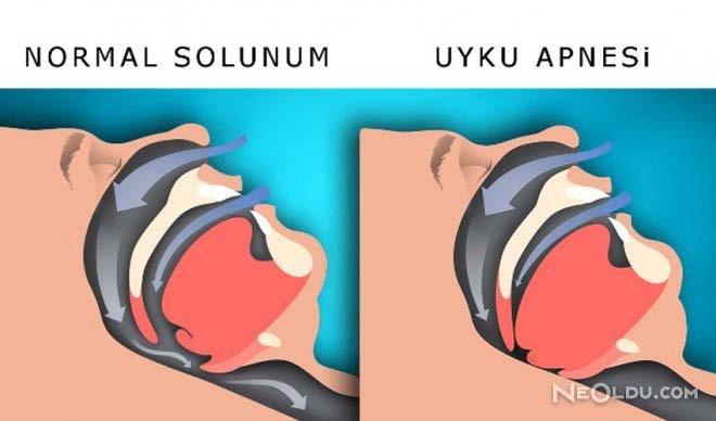 Postoperatif dönemde özellikle ilk 24 saat içinde yaygın olarak görülen, ateş ve