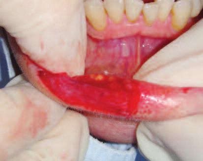 Aydoğdu et al. Oral and Maxillofacial Surgery RESİM 2: Olgunun operasyon sırasındaki görünümü. RESİM 3: Eksizyon ile çıkarılan lezyonun görünümü.