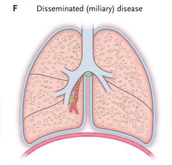 granulomlar Menenjit, artrit, osteomiyelit, peritonit [±] RADYOLOJİ: Miliyer görünüm TANI KLİNİK BULGULAR, TEMAS ÖYKÜSÜ Akciğer