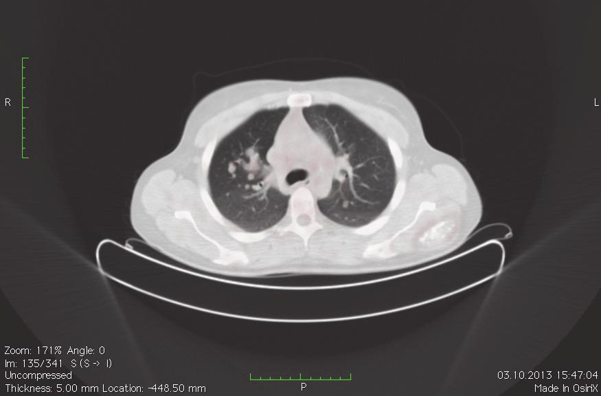 BİLATERAL AKCİĞER METASTAZI İLE BİRLİKTE İSKELETDIŞI YERLEŞİM Grafilerde, pulmoner metastazlar genellikle periferik, değişen