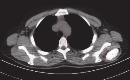 Burada atipik klinik prezentasyonlu, bilateral akciğer ve endobronşiyal metastazlı, iskelet dışı mezankimal yerleşimli