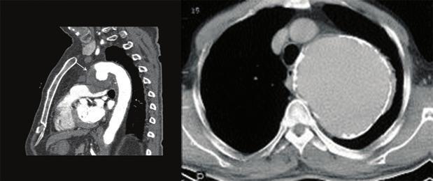 VASKÜLER PATOLOJİLER Mediyastende lokalize torasik aortun çıkan aort ve arkus aorta bölümlerinde lokalize bulunan patolojiler mediyastinal kitleye benzer bulgu verebilir.