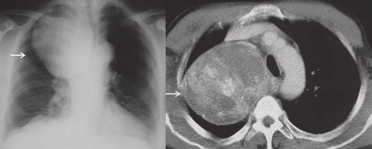 Mediyastinal kitle bulunan olgularda ayırıcı tanıda hastanın yaşı, tümörün lokalizasyonu, morfolojik yapısı, büyüme paterni ve tümör belirteçlerinin önemli yeri vardır (1,2).