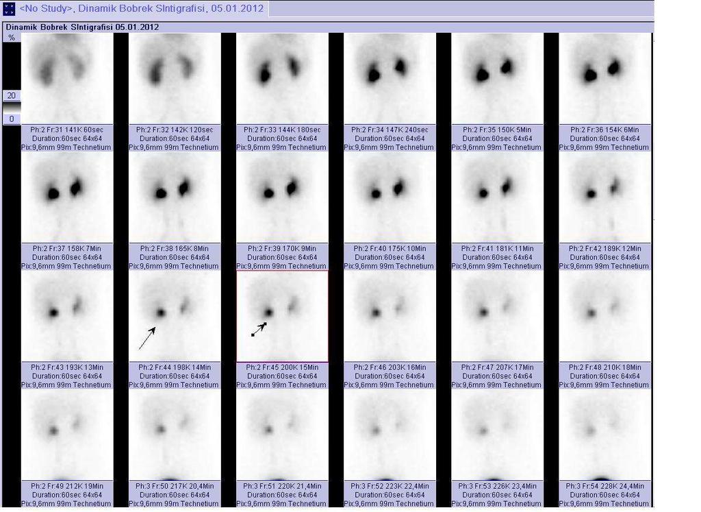 Meckel Divertikülü Sintigrafisi posterior imajlar Resim 2a.