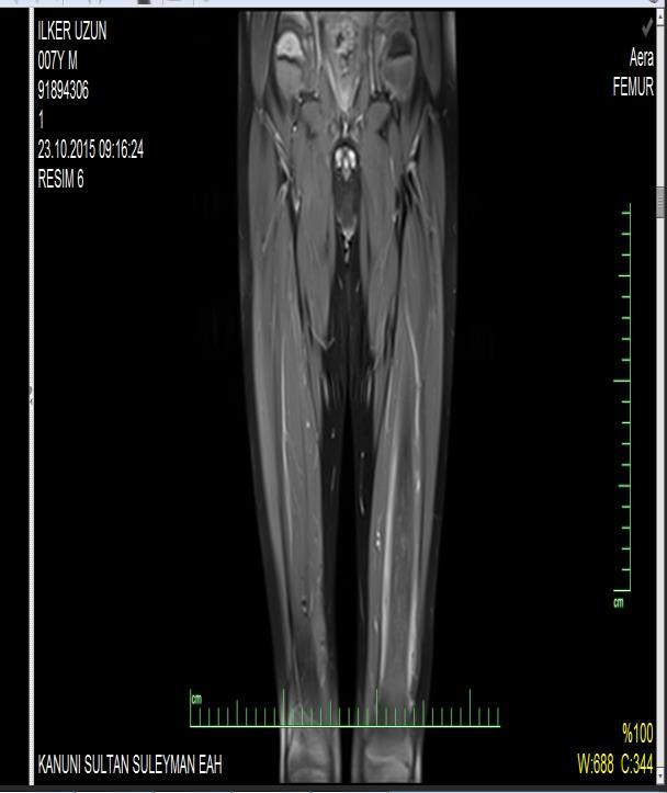 MR Her iki femur özellikle orta ve distal diafizer kesimlerinde kemik iliği belirgin