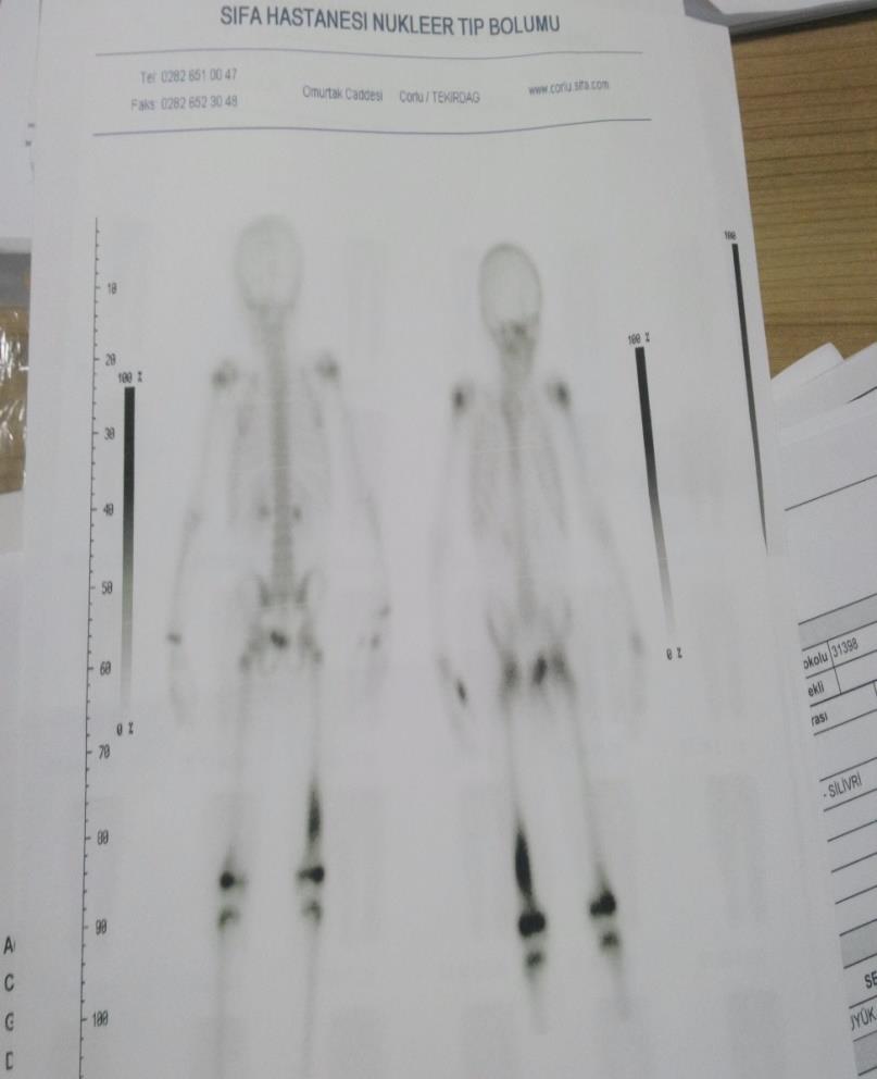 3 fazlı Kemik Sintigrafisi (Mayıs 2016) sağ femur distalinde metafizden diafize uzanan alanda aktivite tutulumu artmış, spot fazda da