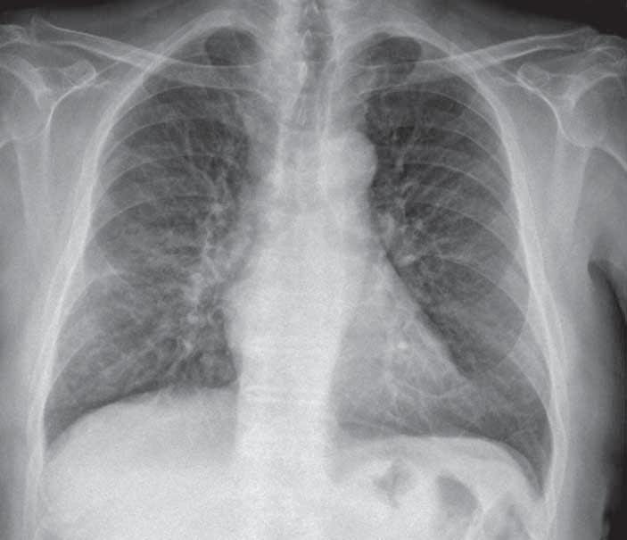Radyolojik İnciler PA akciğer grafisinde sağ hilusun süperiorunda duvarı nispeten kalın halkasal bir lüsensi görülüyor (ok).