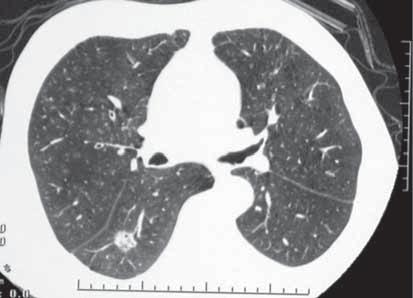 Akciğerde tek nodül Olgu 28 Olgu 1 Altmış üç yaşında erkek hasta, başka bir nedenle çekilen akciğer grafisinde patoloji saptanması üzerine çekilen toraks BT de lezyon izlenmesi