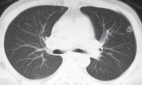 Radyolojik İnciler A B C Resim A-C: Romatoid artritli hastada sağ ve