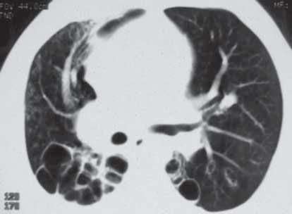 Sürekli öksürük ve balgam yakınması olan hasta Olgu 33 Kırk dört yaşında erkek hasta nefes darlığı, öksürük, balgam ve ara ara olan az miktarda