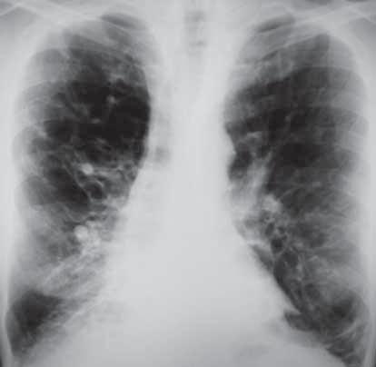 Olgu 33 Cevaplar A B 156 Resim 1: PA akciğer grafisinde her iki akciğerin alt zonunda daha belirgin olmak üzere, kalın duvarlı tübüler opasiteler görülüyor (oklar).