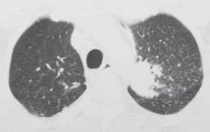 Sol akciğerde iki adet düzensiz sınırlı opasite görülüyor. Sol tarafta plevrada nodüler düzensizlikler izleniyor. B.