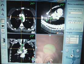 Olgu 36 Cevaplar A B miktar asimetrik lenfadenopati söz konusudur. Bu hastada ön mediastende görülen yumuşak dokuyu lenfadenopati veya timik neoplazi ile karıştırmamak gerekir.