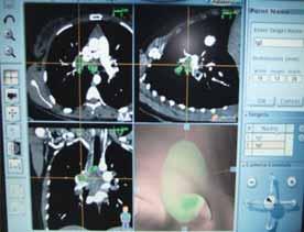 2: Toraks BT de multipl mediastinal lenfadenopatiler saptanan hastaya elektromanyetik navigasyon bronkoskopi (ENB) yapıldı.