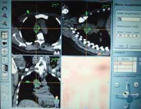 Cevaplar Olgu 37 olabileceği gibi bazı iyi diferansiye bronkioloalveoler kanserlerin bu sürelerden daha uzun zamanda hacimsel olarak iki katına çıkabileceği (yani çok yavaş büyüyebileceği)