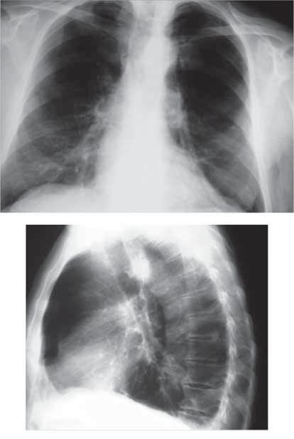 Olgu 39 Cevaplar 182 A B Resim 1: A, B) PA ve yan akciğer grafilerinde sol akciğerde üst lobda spiküler kenarlı bir kitle görülüyor (oklar).