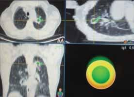 Bronkoskopi sırasında transbronşiyal iğne aspirasyonu (TBİA) çok daha az invaziv bir yöntemdir.