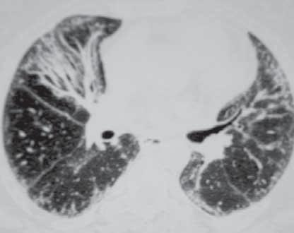 Bunların dışında olağan interstisyel pnömoni, yaygın alveoler hasar, vaskülit, pulmoner arterlerde fibroproliferatif değişiklikler, yaygın akciğer kanaması, kronik eozinofilik pnömoni de görülebilir.