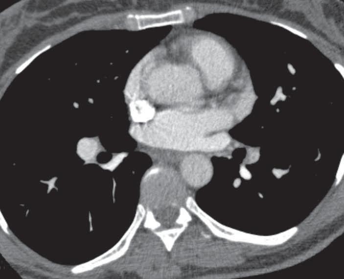 Radyolojik İnciler Sağ ve sol alt lob pulmoner arterleri oklar ile gösterilmiştir. Sol alt lob pulmoner arteri sağa göre daha ince ve düzensizdir.