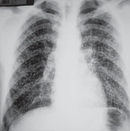 Cevaplar Olgu 8 Resim 1: Akselere silikosiz. Resim 3: Progresif masif fibroz. Resim 2: Basit silikoz.