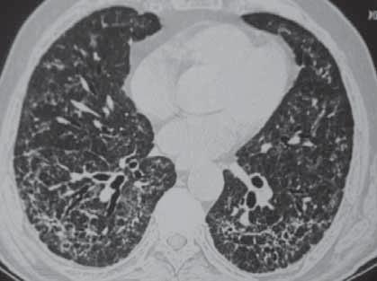 Olgu 9 Cevaplar 1: Bu bulgular interstisyel akciğer hastalığı ile uyumludur.