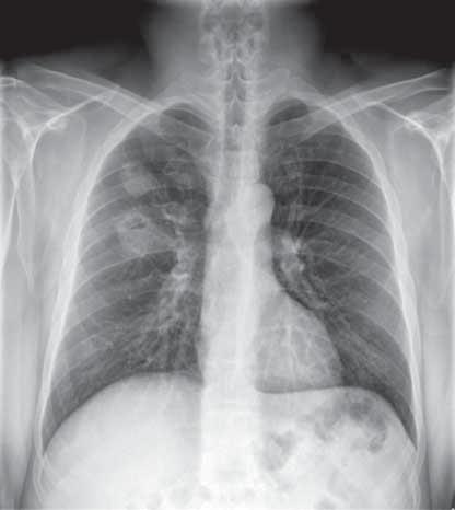 Olgu 11 Cevaplar A B Resim 1: PA göğüs radyografisinde sağ akciğerde üst zonda iki adet düzgün kenarlı nodüler opasite izleniyor. Lezyonların ikisinde de kavitasyon mevcut.