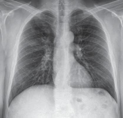 Cevaplar Olgu 11 Resim 3: Tedavi sonrası kontrol iki yönlü akciğer filminde radyolojik bulgularda belirgin gerileme izlendi. daha fazla görülür.