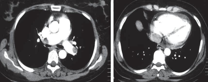 Olgu 12 Cevaplar A B RV LV Resim 1: A) Pulmoner arterler düzeyinden geçen kesitte sağ ve sol pulmoner arterlerde merkezi yerleşim gösteren dolum defektleri görülüyor (okbaşı).