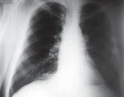 Kuru öksürüğü olan hasta ve anormal akciğer grafisi.