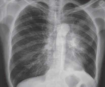 Olgu 1 Cevaplar A B PE Resim 1: A) PA göğüs grafisinde sol akciğerde orta zonda opasite artışı görülüyor.