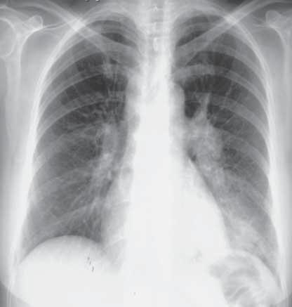 Olgu 17 Cevaplar A B Resim 1: PA akciğer grafisinde sol hiler bölgede düzgün kenarlı, lobüle konturlu bir büyüme görülüyor (oklar).