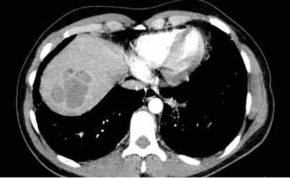 Bunların yanı sıra bazı olgularda lenfanjitik yayılıma bağlı interlobüler septal kalınlaşmalar, plevral effüzyon, mediastinal/hiler lenf bezi büyümeleri de görülebilir.