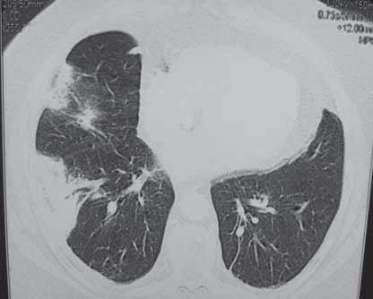 Olgu 20 Cevaplar çizgisel atelektaziler, fokal konsolidasyonlar, plevral effüzyon olarak sayılabilir. Bu parankimal ve plevral bulgular genellikle pulmoner emboli için spesifik değildir.