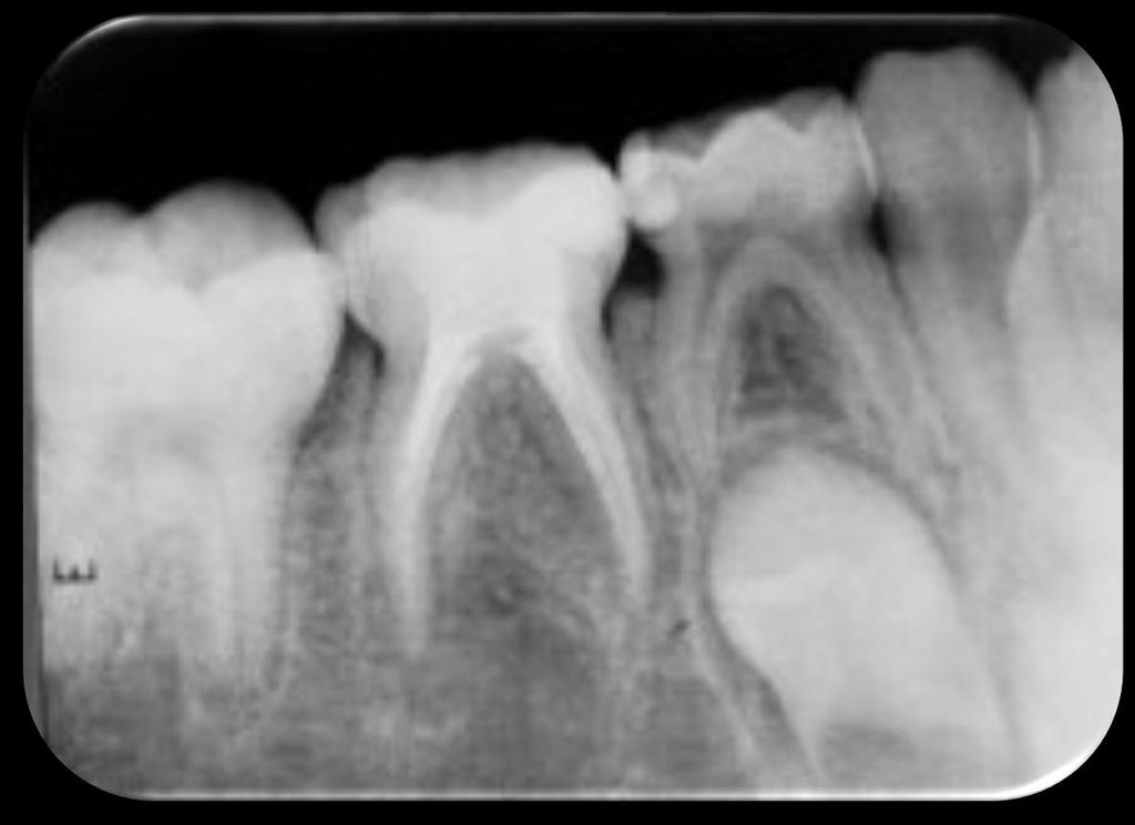 dişlerinde kanal tedavisi endikasyonu