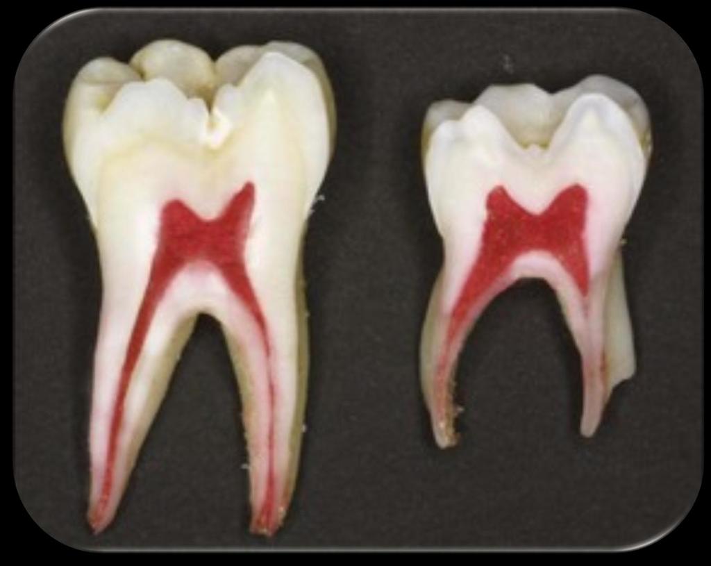 Süt Dişleri ve Daimi Dişler Arasındaki Farklar Süt molar dişlerde