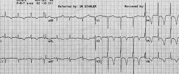 Örnek ekg