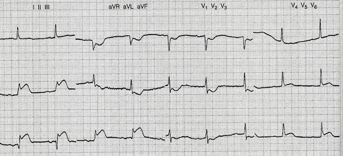 Örnek ekg