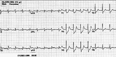 Örnek ekg