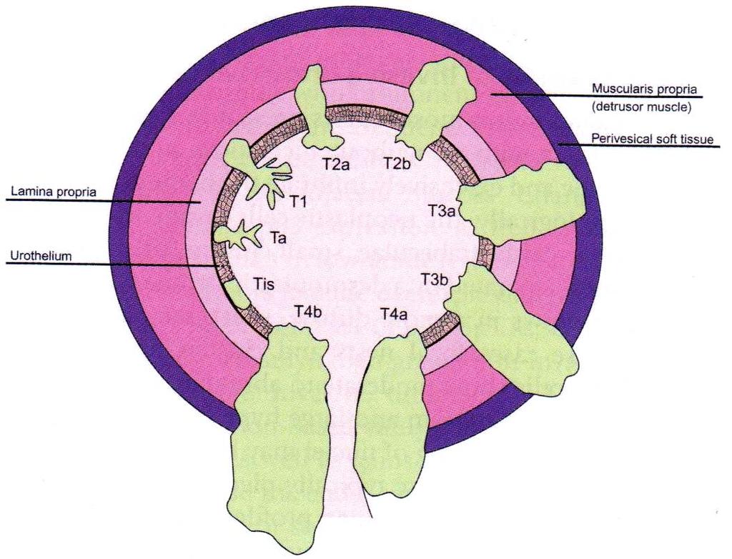 17 Şekil 4. Mesane karsinomunda TNM Evreleme sistemi (31). Mesane kanserinde 2010 TNM evrelemesi (41).