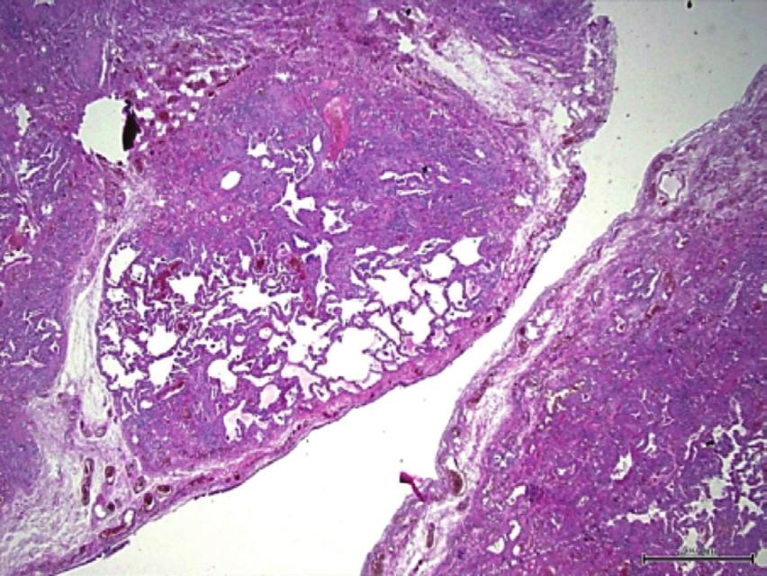 34 İdiyopatik Pulmoner Fibroziste Patolojik Bulgular ve Özellikler / Pathological Findings and Characteristics in son olarak alveolar evre vardır.