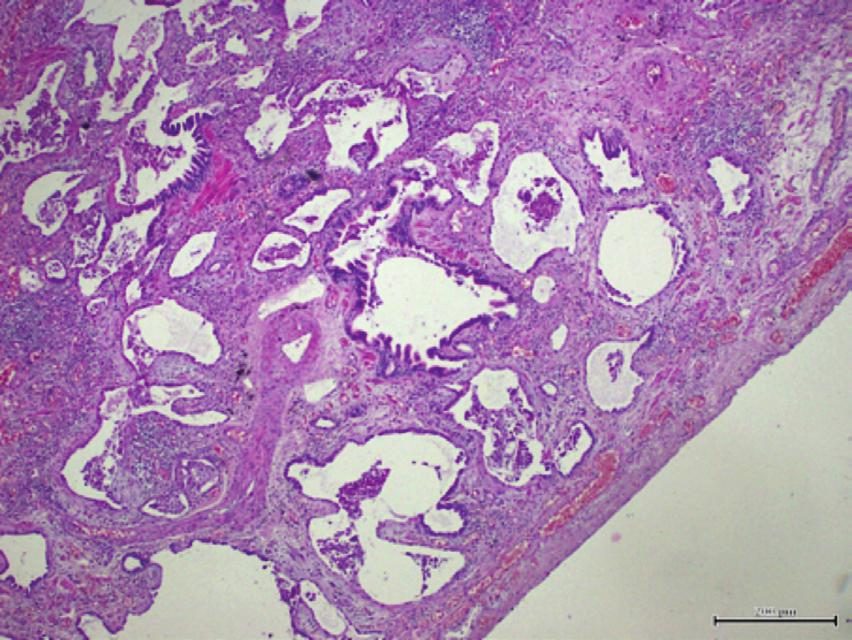 Histopatolojik incelemede UİP paternine özgü tipik lezyonlar, çatı hasarı oluşturan yamasal interstisyel fibroz, bal peteği akciğer ve fibroblatik fokusdur.