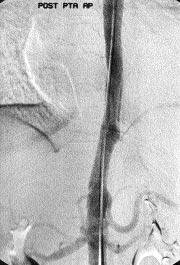 PTA sonras kontrol torakal aortografide stenozun balon dilatasyonlara totale yak n cevap verdi i izlenmektedir. D. 4 y l sonra T1 a rl kl sagital MRG kesitinde restenoz görülmemektedir.