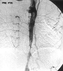 Tart flma Takayasu arteriti segmenter olarak aorta, aortan n ana dallar n ve pulmoner arterleri tutan nonspesifik kronik inflamatuar bir arteriyopatidir.