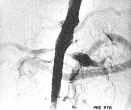 A B C D Resim 3. 5 no lu olgu. A. Abdominal aortografide her iki renal arterlerin orijinlerinde %90-95 stenoz izlenmektedir. B. PTA sonras kontrol aortografide balon dilatasyonlara yeterli cevap izlenmektedir.