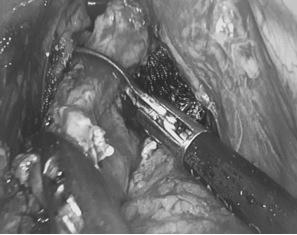 Radyal genişleyebilen bir trokar, eksternal sfinkterin tam ortasından sokularak laparoskopi