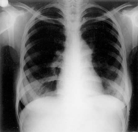 Primer Antifosfolipid Sendromu: Olgu Sunumu Antifosfolipid sendromu (APLS), venöz-arteryel trombozis, trombositopeni, tekrarlayan abortus ve nörolojik bozuklukların yanısıra lupus antikoagülanı (LA)