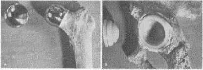 kemik hasarları ancak Şekil 1.22. de görüldüğü gibi implant uygulamaları ile tamir edilebilmektedir Hasarlı Kemik Şekil 1.22. TMZF alaşımından imal edilen implantların kemik implantasyonunda kullanımı (Wang vd.